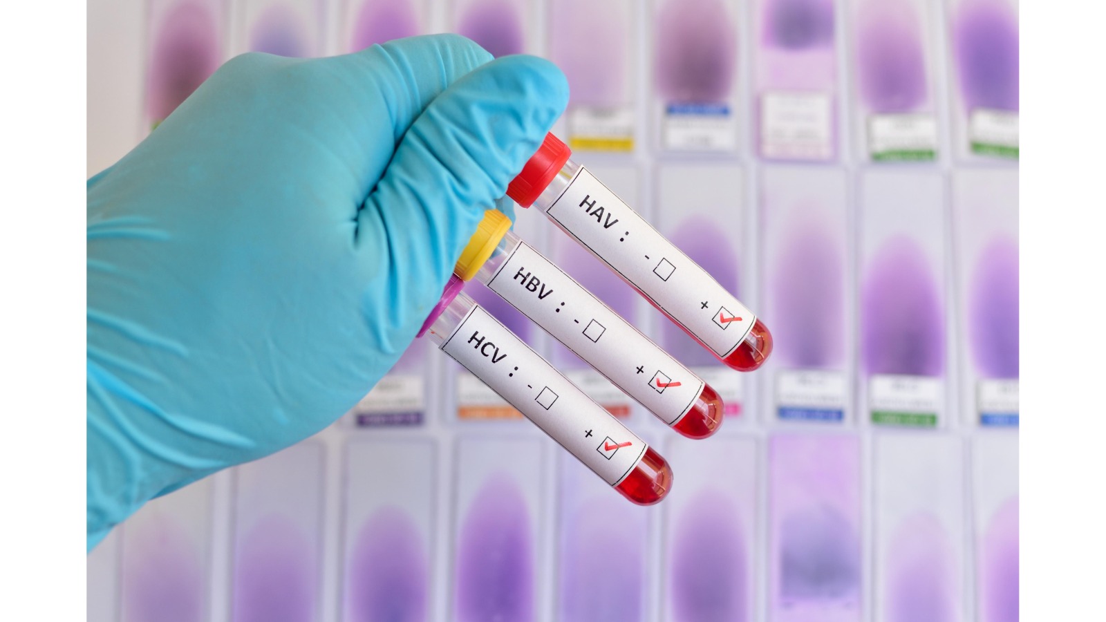 Un profesional de la salud discutiendo la concientización sobre la hepatitis con un paciente. Foto: Clarín