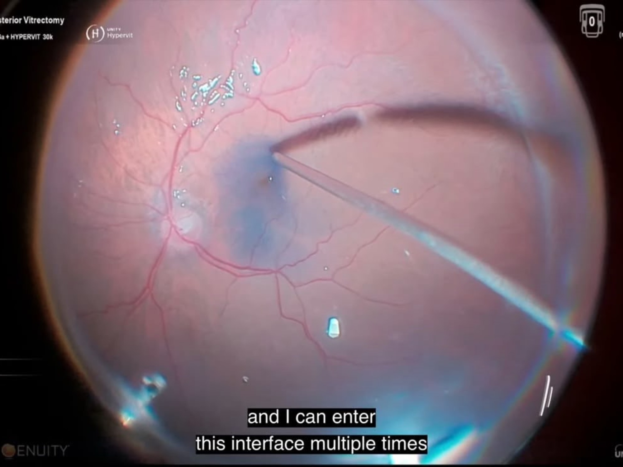 Premio internacional para oftalmólogos argentinos por innovación en cirugía retinal. Foto: Clarín